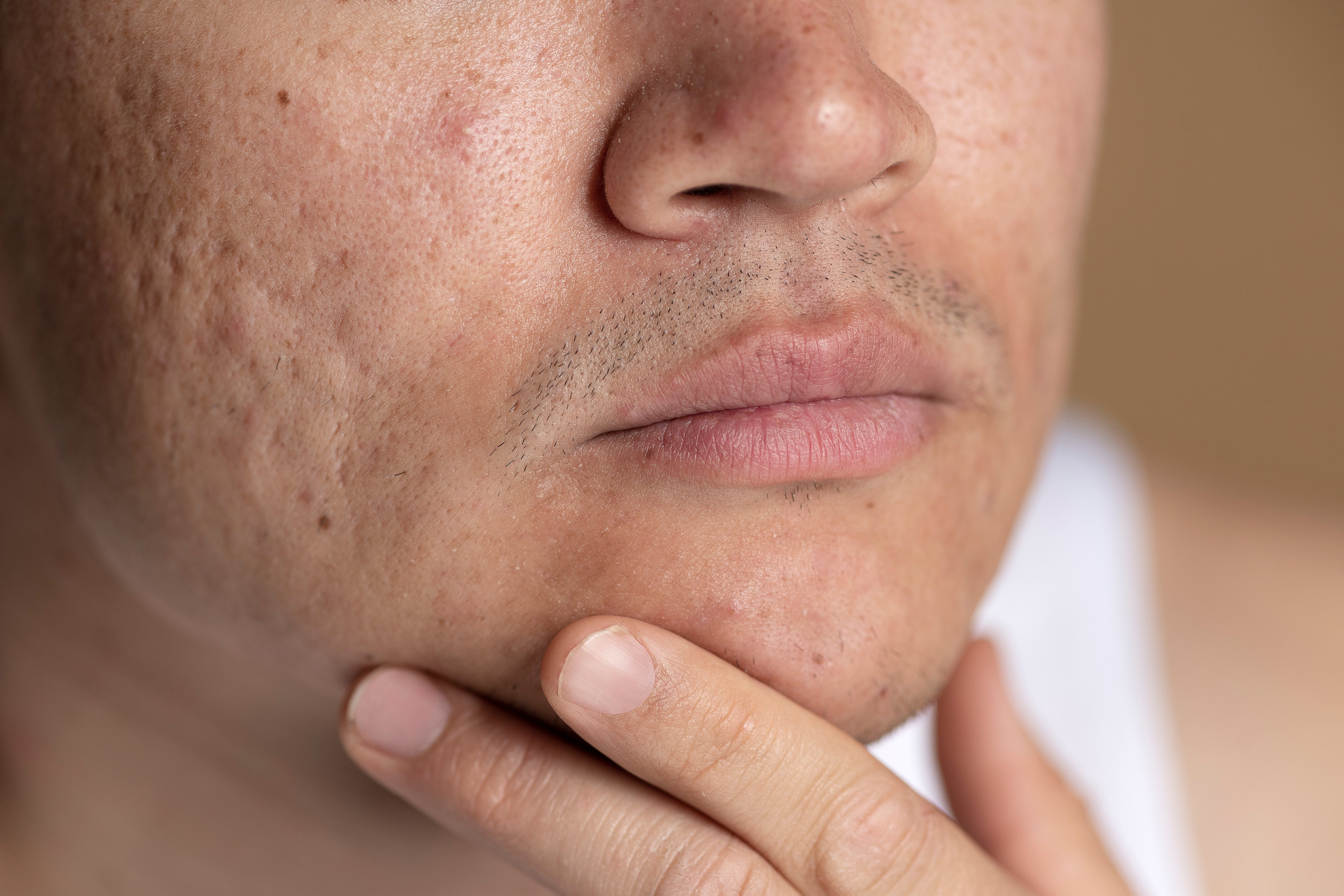 acne causes and treatment