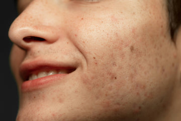 acne prone skin routine, skincare routine for acne prone skin , acne skincare India, oily & acne prone skin care, best skincare routine for acne prone skin in India